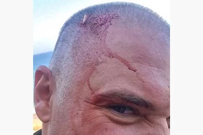 Köpək balığı insanın başını dişlədi və dişini sındırdı